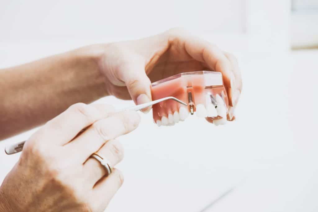 implantes-dentales-precios