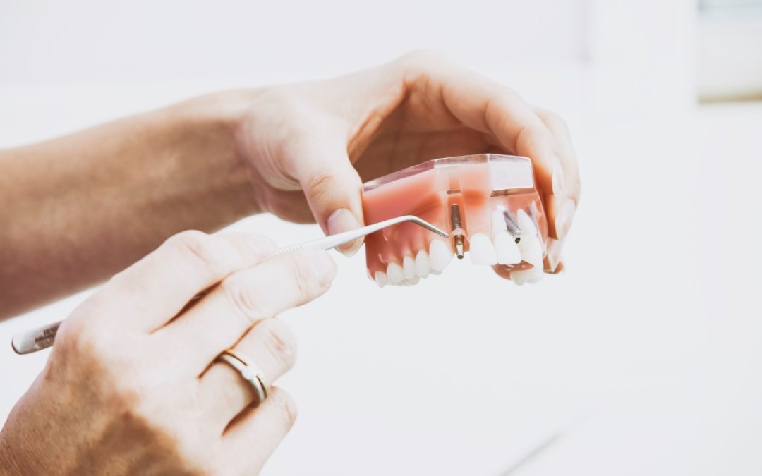 ¿Qué precio tiene un implante dental?