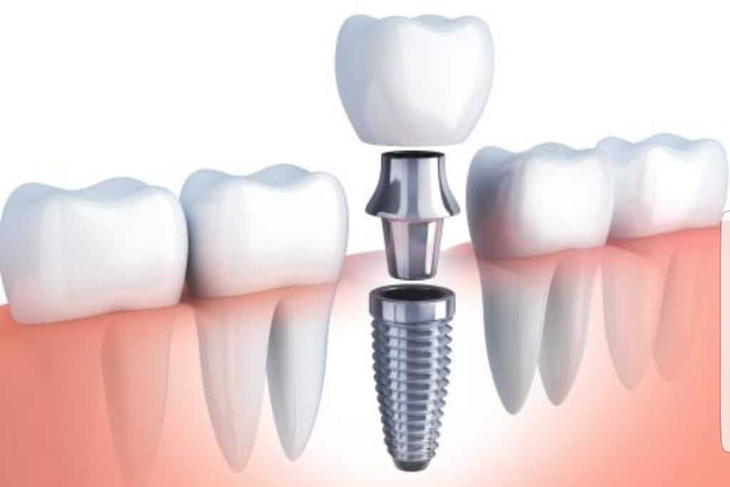tipos-de-protesis-dentales-fijas