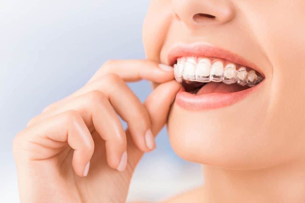 que-es-mejor-alineadent-o-invisalign