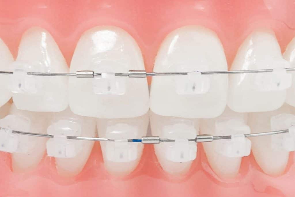 cuales-son-los-brackets-invisibles-de-nuestra-clinica-dental-de-logrono