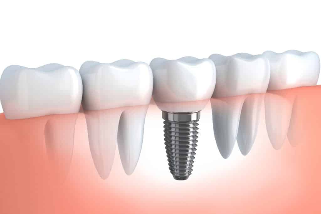 se-nota-un-implante-dental