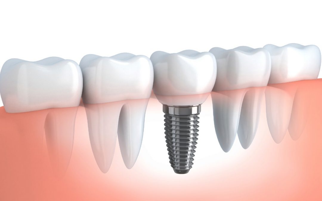 ¿Se nota un implante dental?