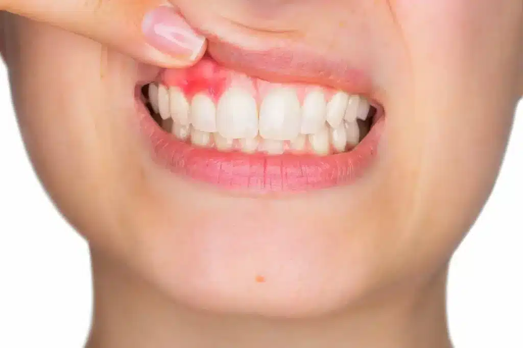 cuando-es-necesario-un-raspado-de-encias-clinica-dental-en-logrono-riojadental
