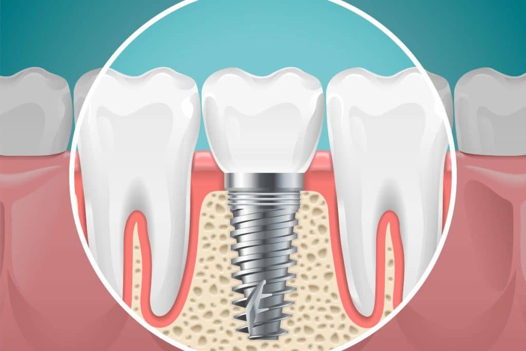 cuidados-postoperatorios-de-los-implantes-dentales