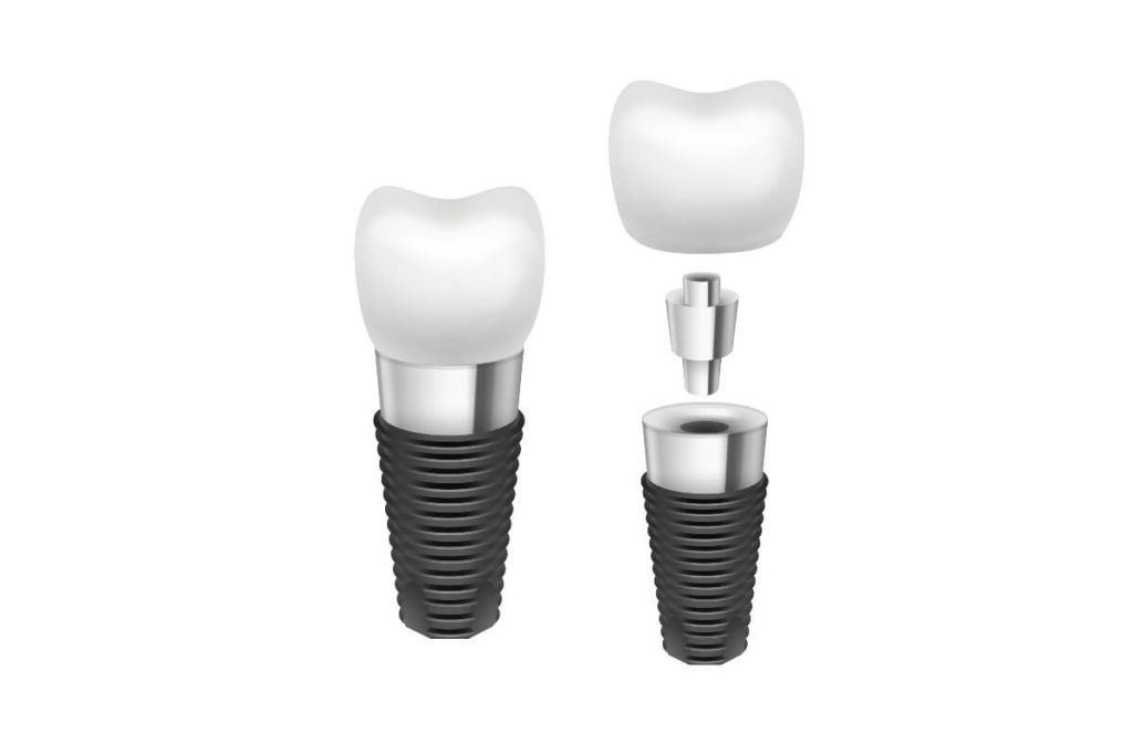 cuales-son-las-partes-de-un-implante-dental