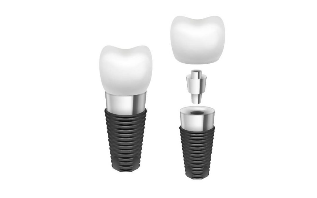 ¿Cuáles son las partes de un implante dental?