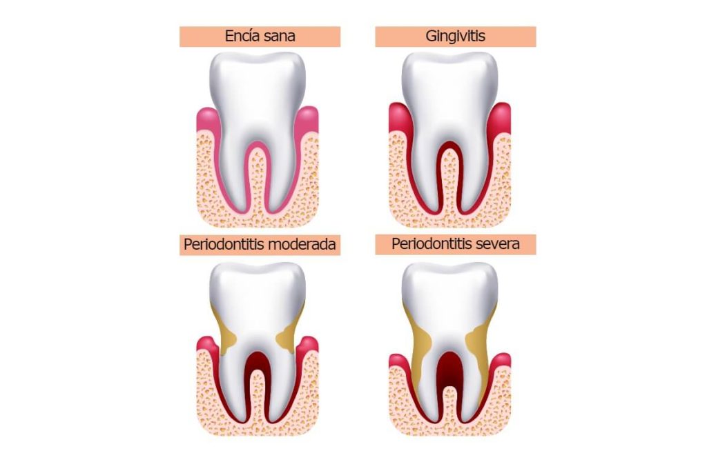 la-periodontitis-se-cura
