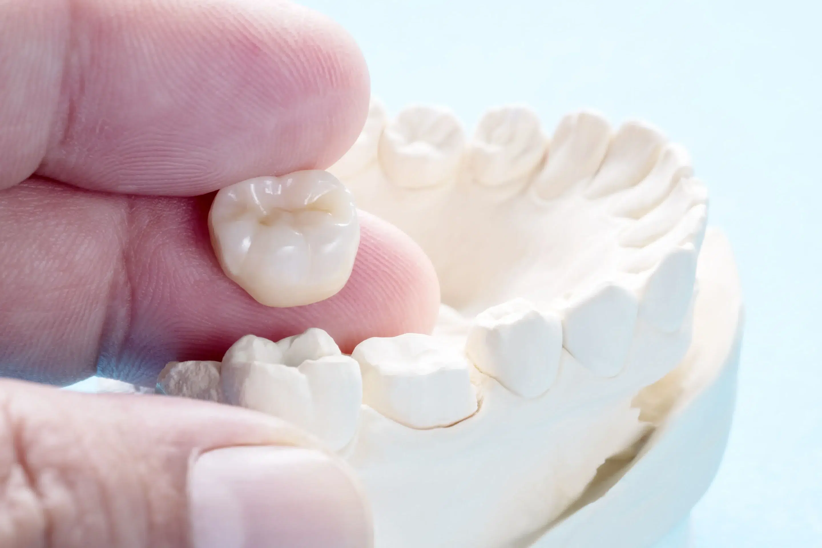coronas dentales que son clinica dental en logroño riojadental estetica dental implantologia