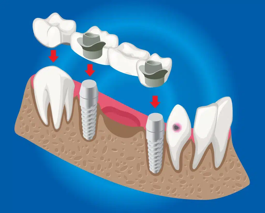 Puentes Dentales - Pérdida De Dientes En Logroño riojadental
