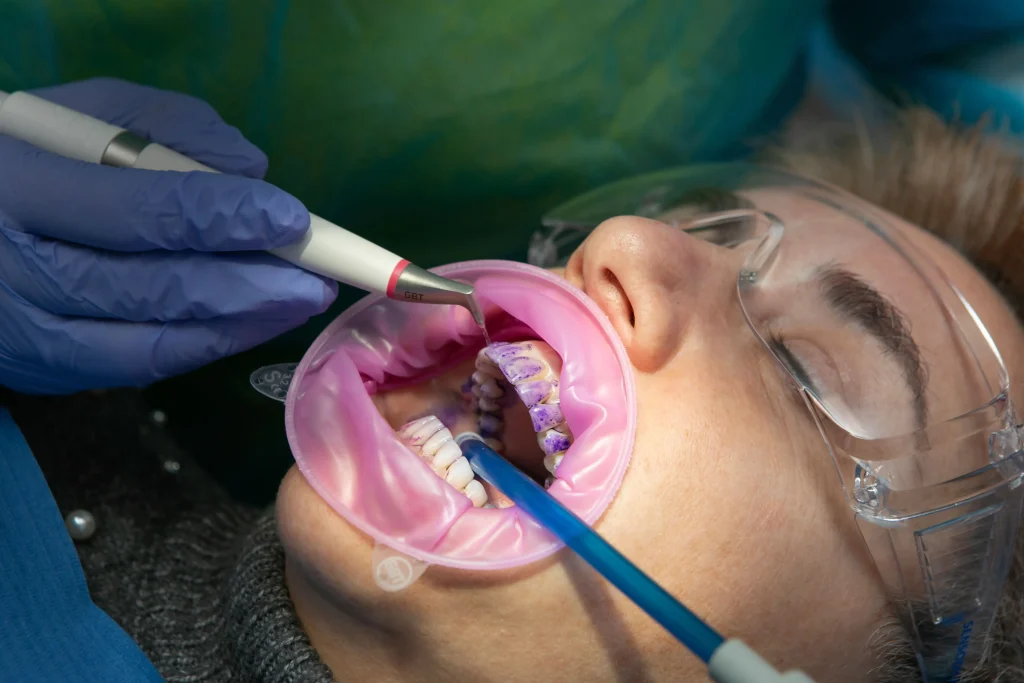 Inicio 78 Limpieza dental con sistema GBT: la nueva forma de cuidar tu sonrisa sin molestias