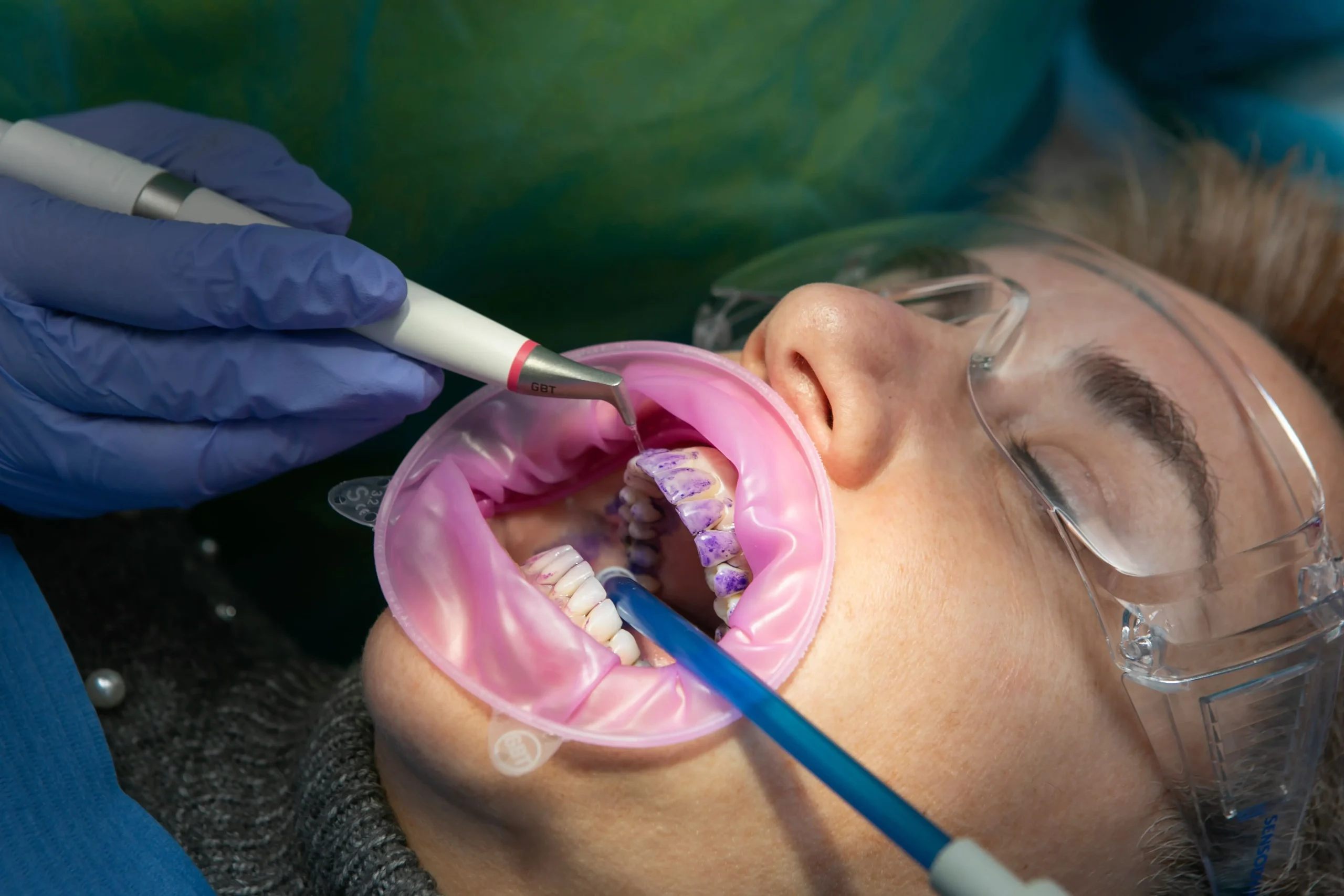 Blog 5 Limpieza dental con sistema GBT: la nueva forma de cuidar tu sonrisa sin molestias