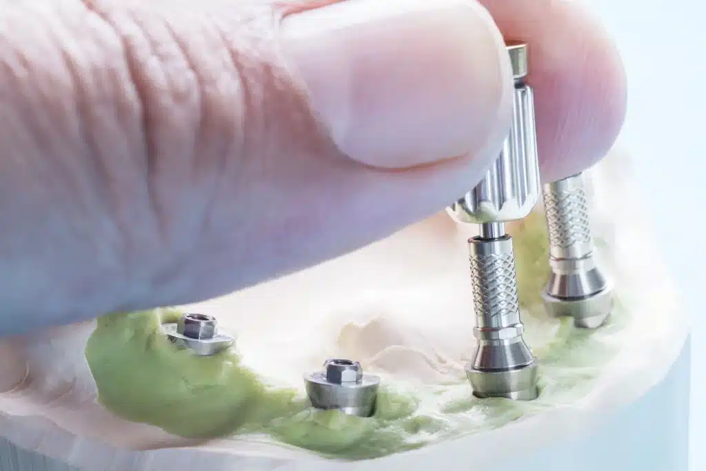 Implantes de carga inmediata en qué casos son realmente una opción logroño riojadental