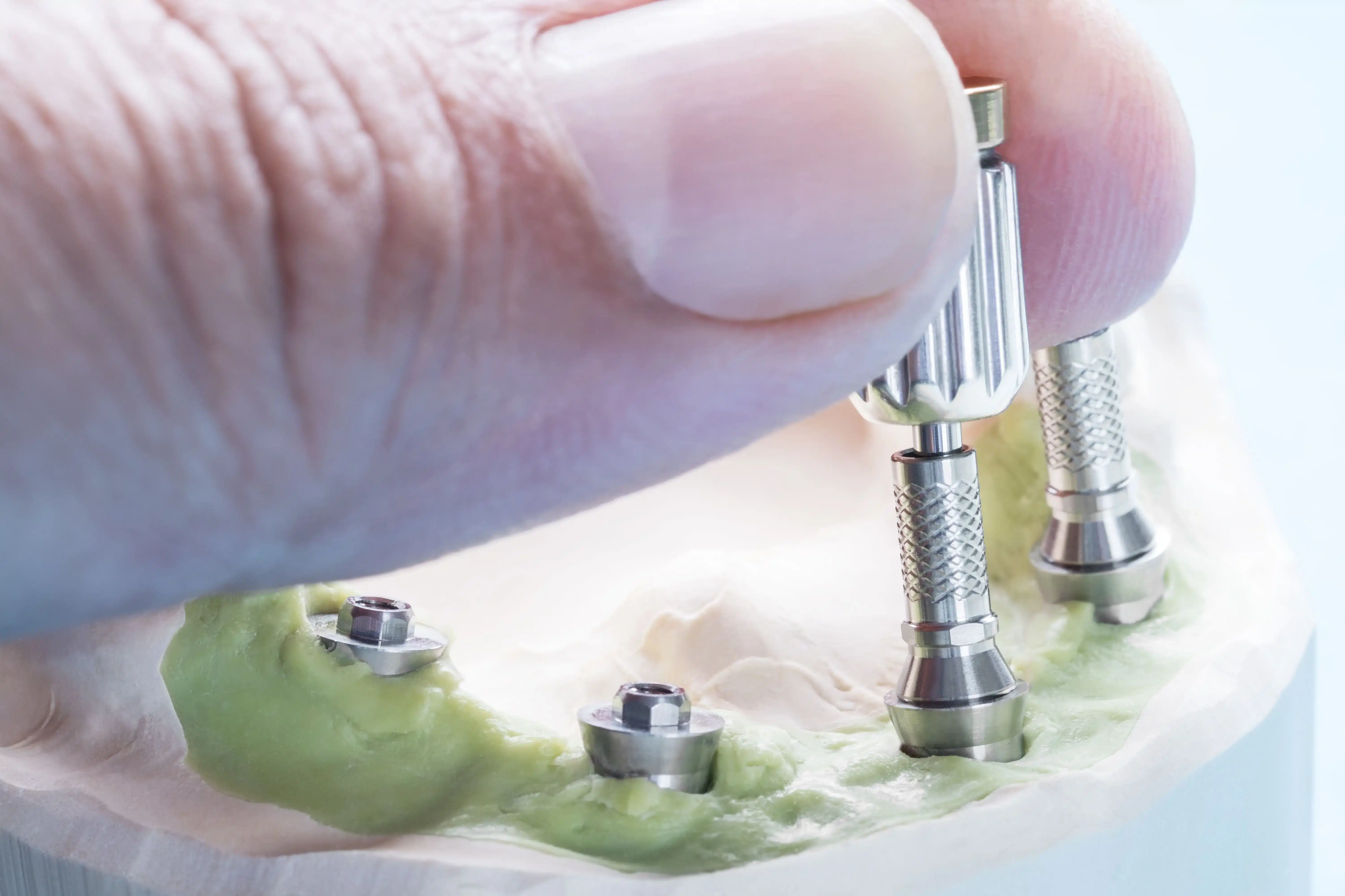 Blog 4 Implantes de carga inmediata en qué casos son realmente una opción logroño riojadental