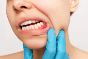 Mantenimiento periodontal por qué no basta con un solo tratamiento en logroño riojadental